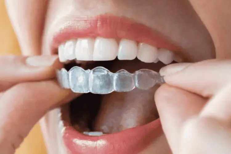Invisalign Clear Aligners